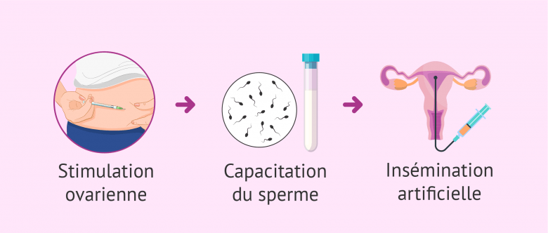 Possibilités de tomber enceinte par insémination artificielle avec ce