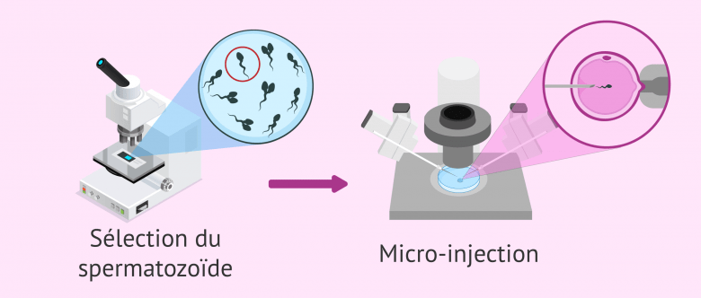 Imsi Microscope La technique de l'IMSI