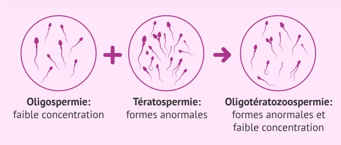 Imagen: Oligoteratozoospermie