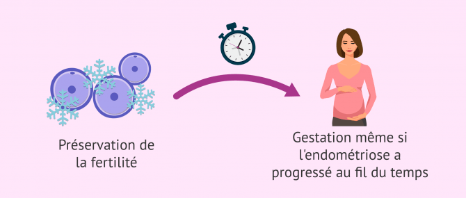 Imagen: Endométriose et préservation de la fertilité