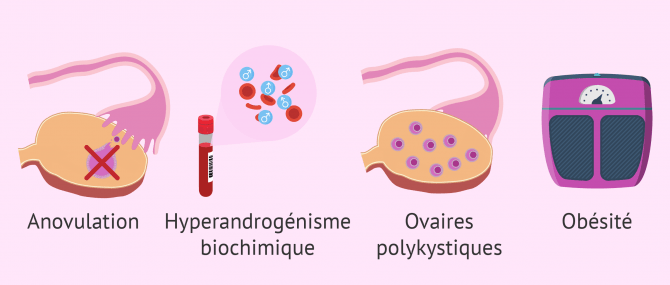 Imagen: Symptômes SOPK