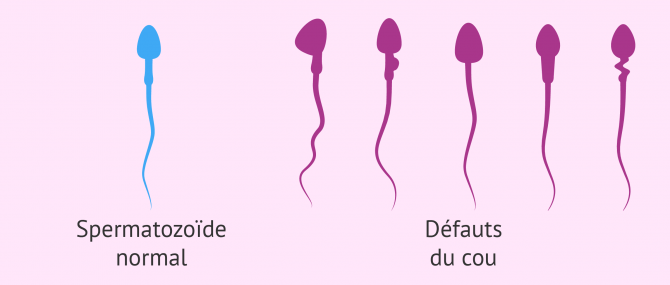 Imagen: Tératozoospermie déformations du cou
