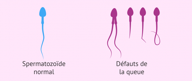 Imagen: Tératozoospermie déformations de la queue