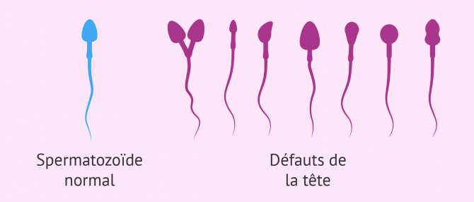Imagen: Tératozoospermie déformations tête