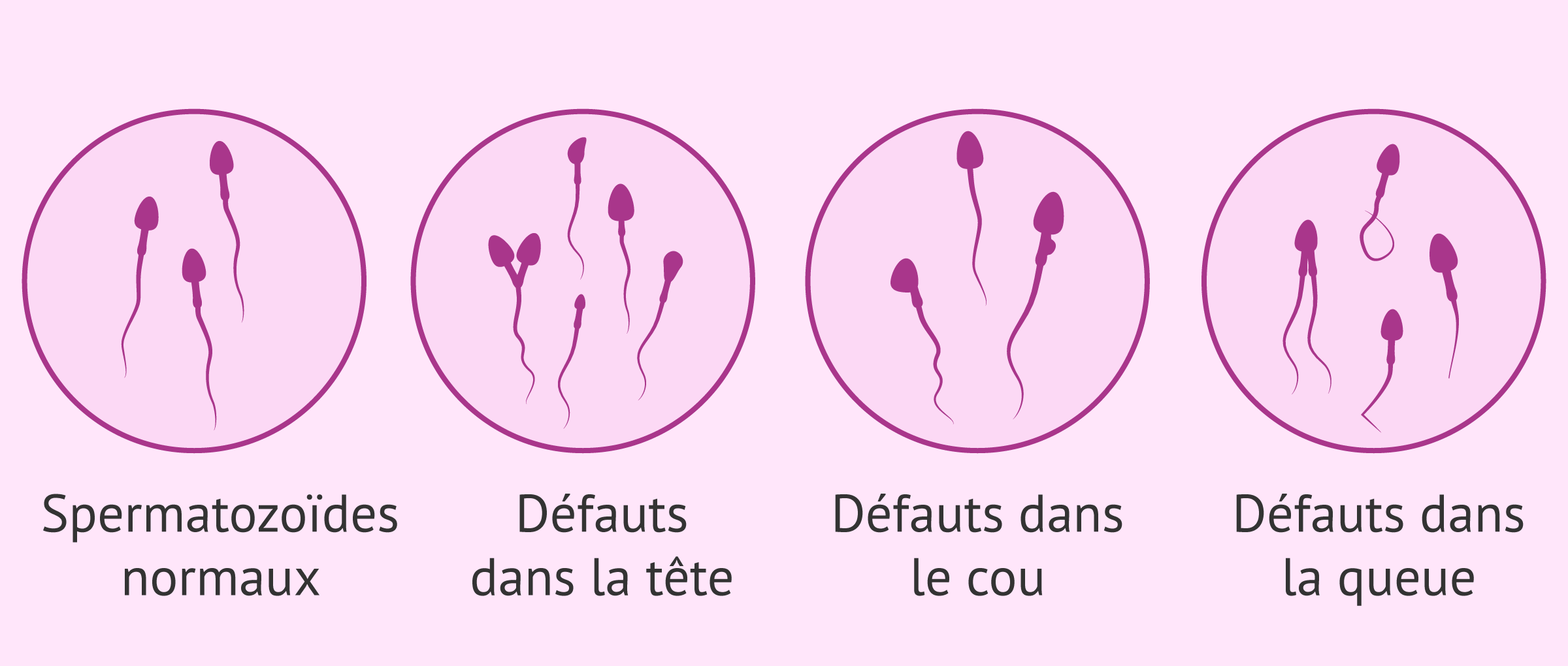 Quels types de malformations spermatiques existe-t-il?