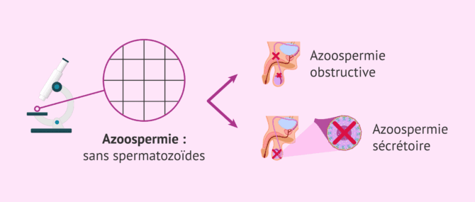 Imagen: Quels sont les types d'azoospermie?