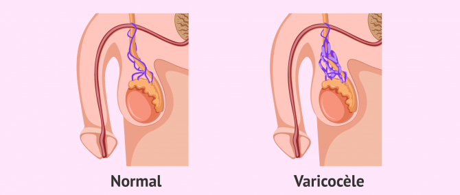 Imagen: varicocele azoospermie