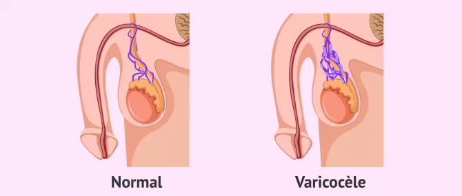 Imagen: varicocele azoospermie