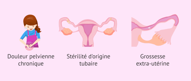 Imagen: Quelles complications la salpingite peut-elle provoquer?