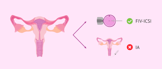 Imagen: Grossesse avec salpingite