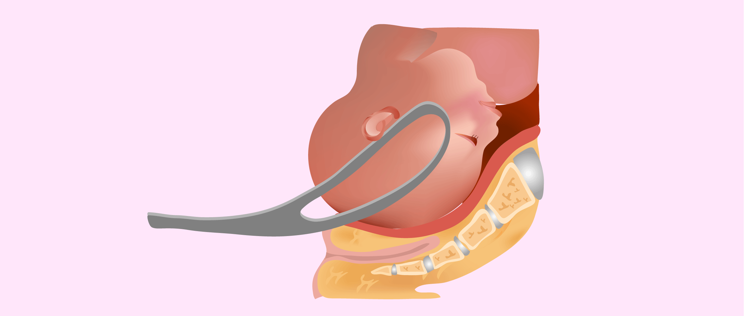 Imagen: Accouchement par forceps