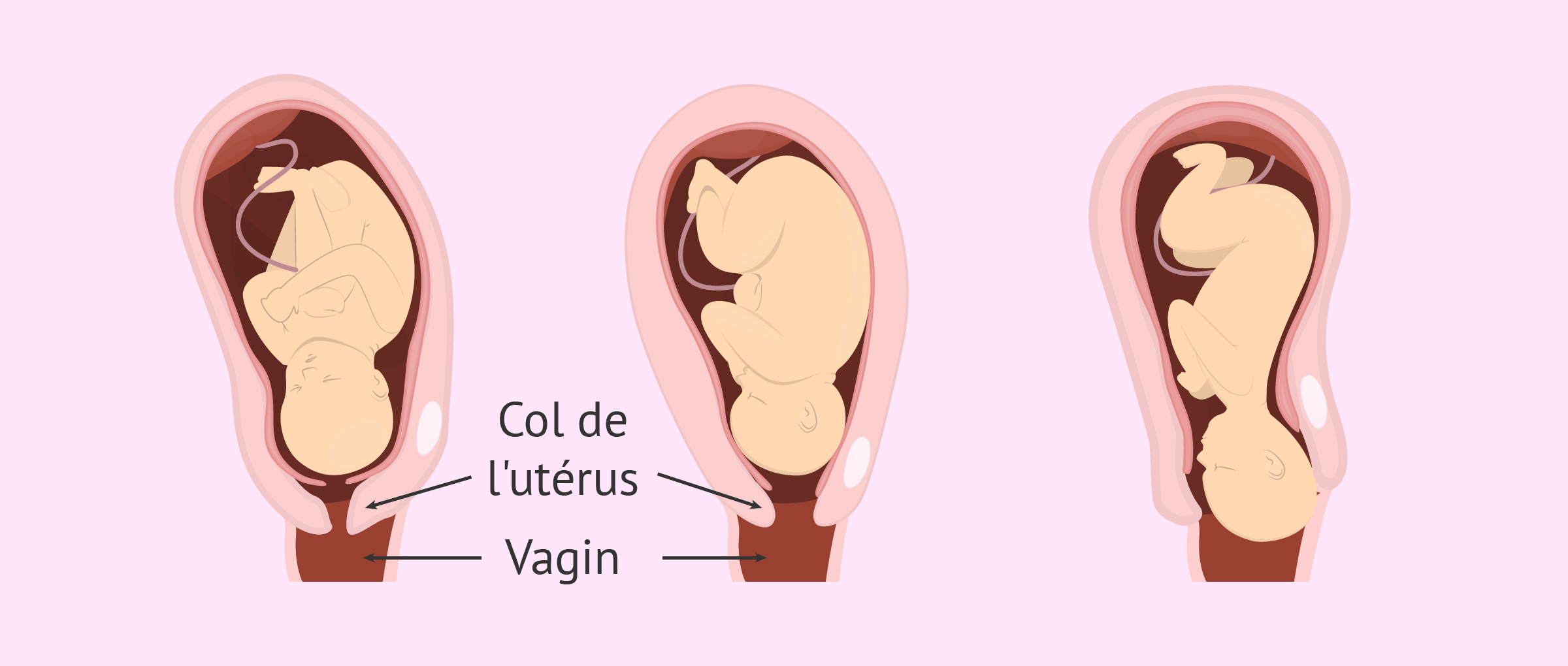 Imagen: Accouchement vaginal