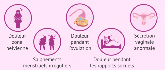 Imagen: Symptômes de la salpingite