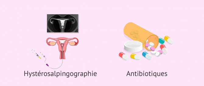 Imagen: traitement salpingite hysterosalpingographie antibiotiques