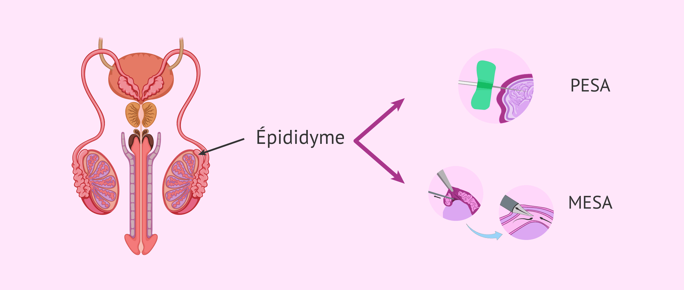 Imagen: PESA et MESA pour l'aspiration de spermatozoïdes de l'épididyme