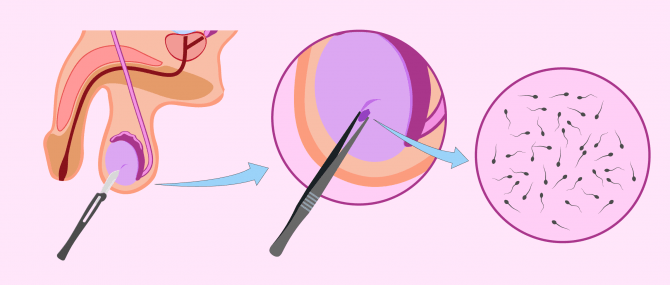 Imagen: Biopsie des testicules