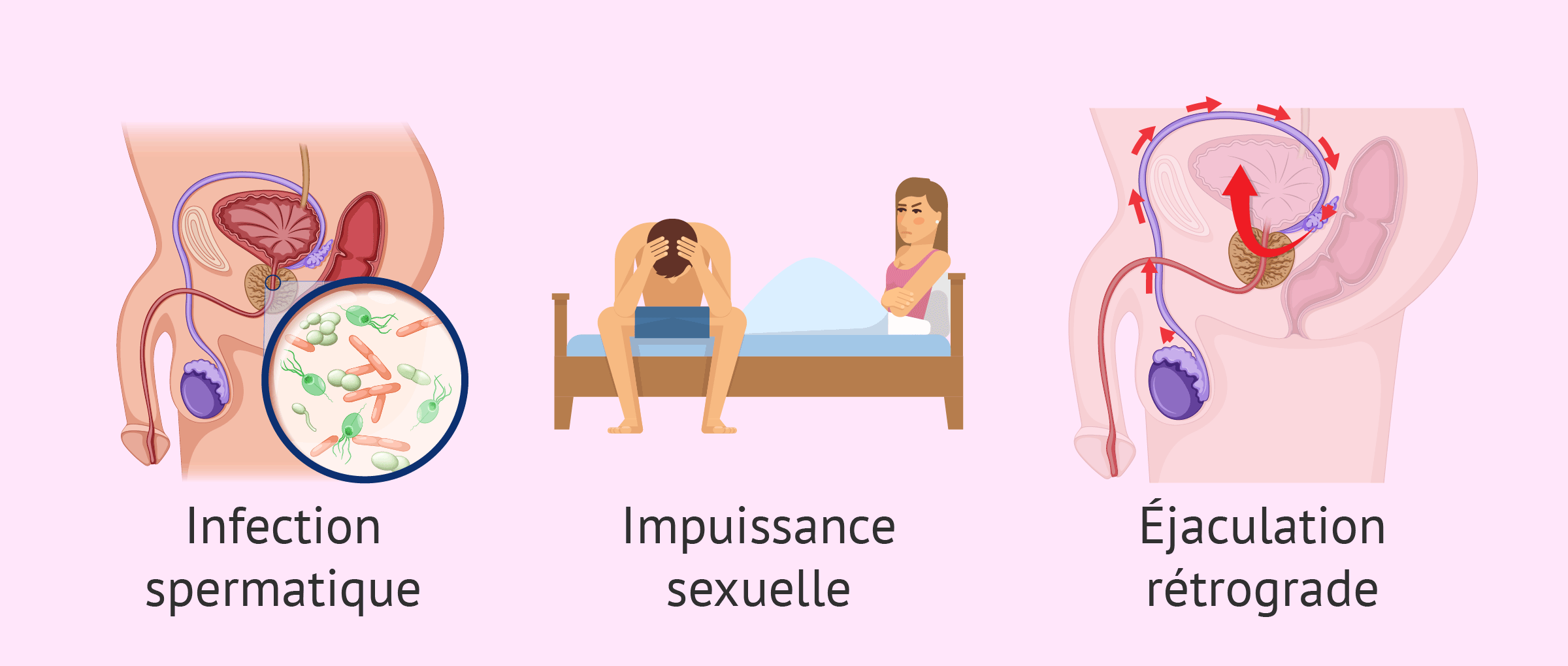 Imagen: Causes de l'infertilité due à un facteur post-testiculaire