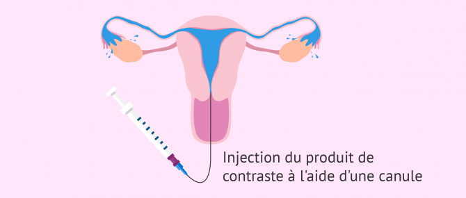 Imagen: Hystérosalpingographie synéchies