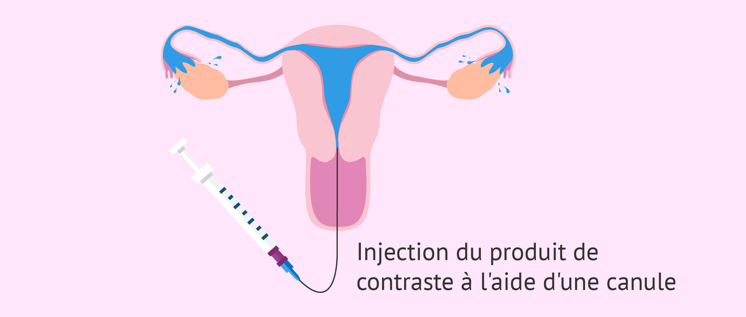 Hystérosalpingographie pour diagnostiquer Asherman