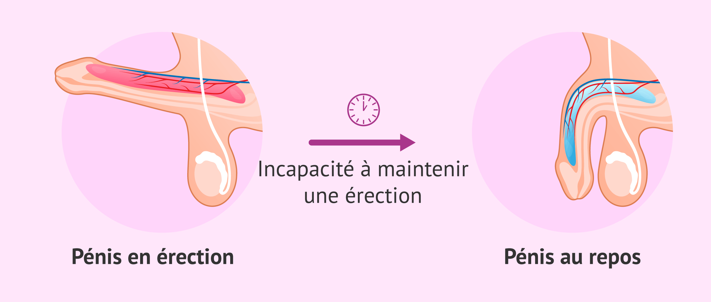 Imagen: Qu'est-ce que l'impuissance sexuelle?