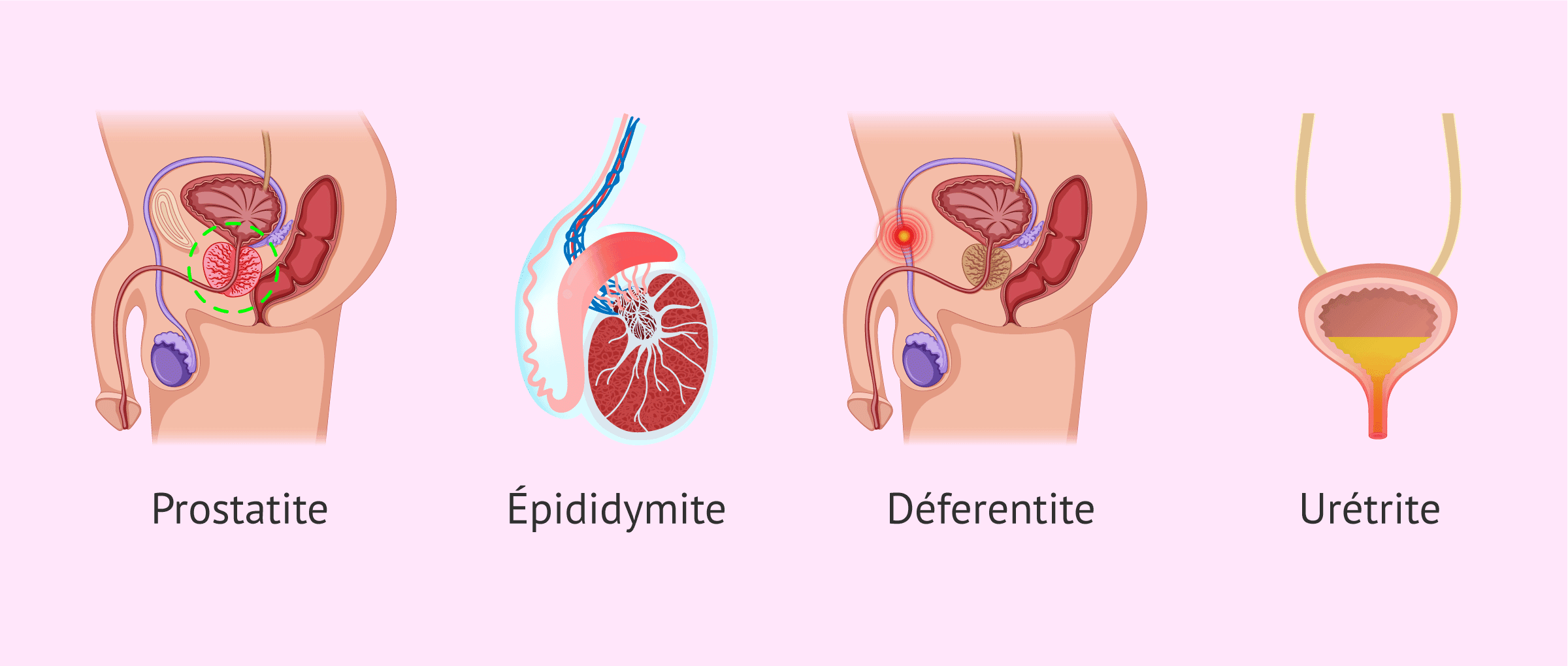 Imagen: Quelles infections séminales existe-t-il?