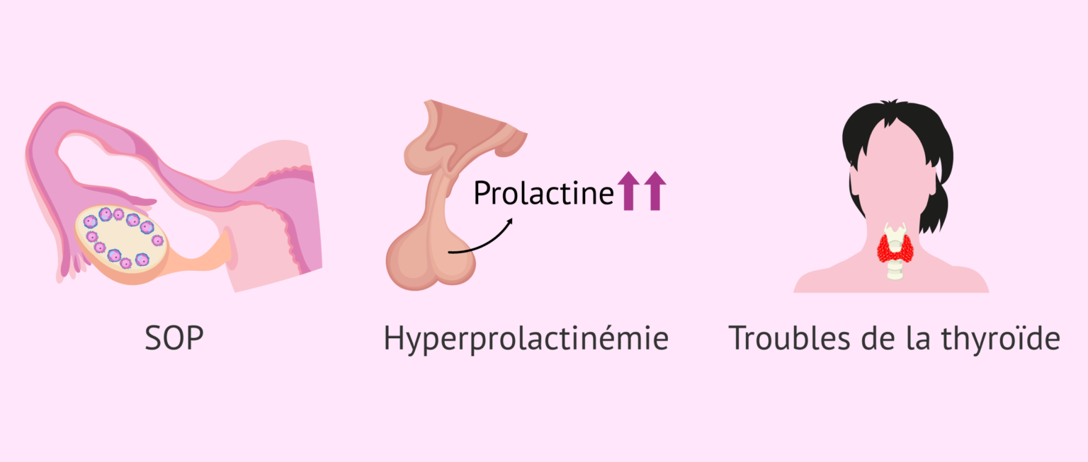 L'anovulation: Causes, test d'ovulation diagnostic et traitement