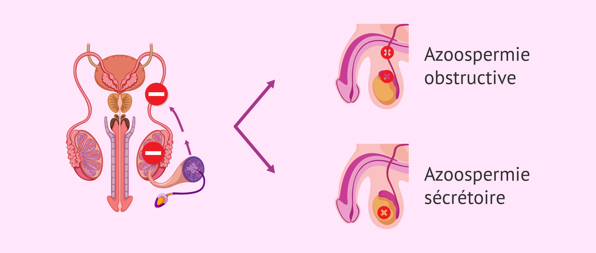 Imagen: Types d'azoospermie : obstructive et sécrétoire