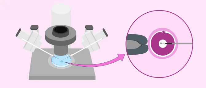 Imagen: ICSI  et micro-injecteur