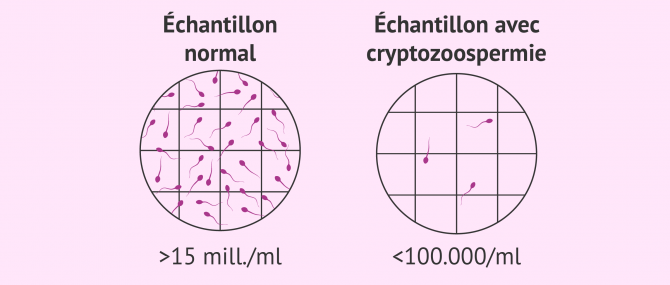 Imagen: Cryptozoospermie