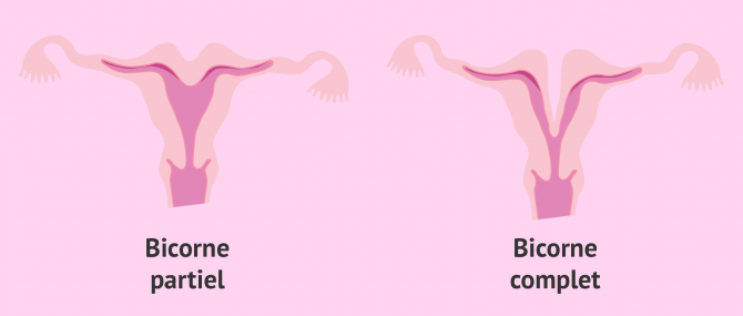 Imagen: Utérus bicorne