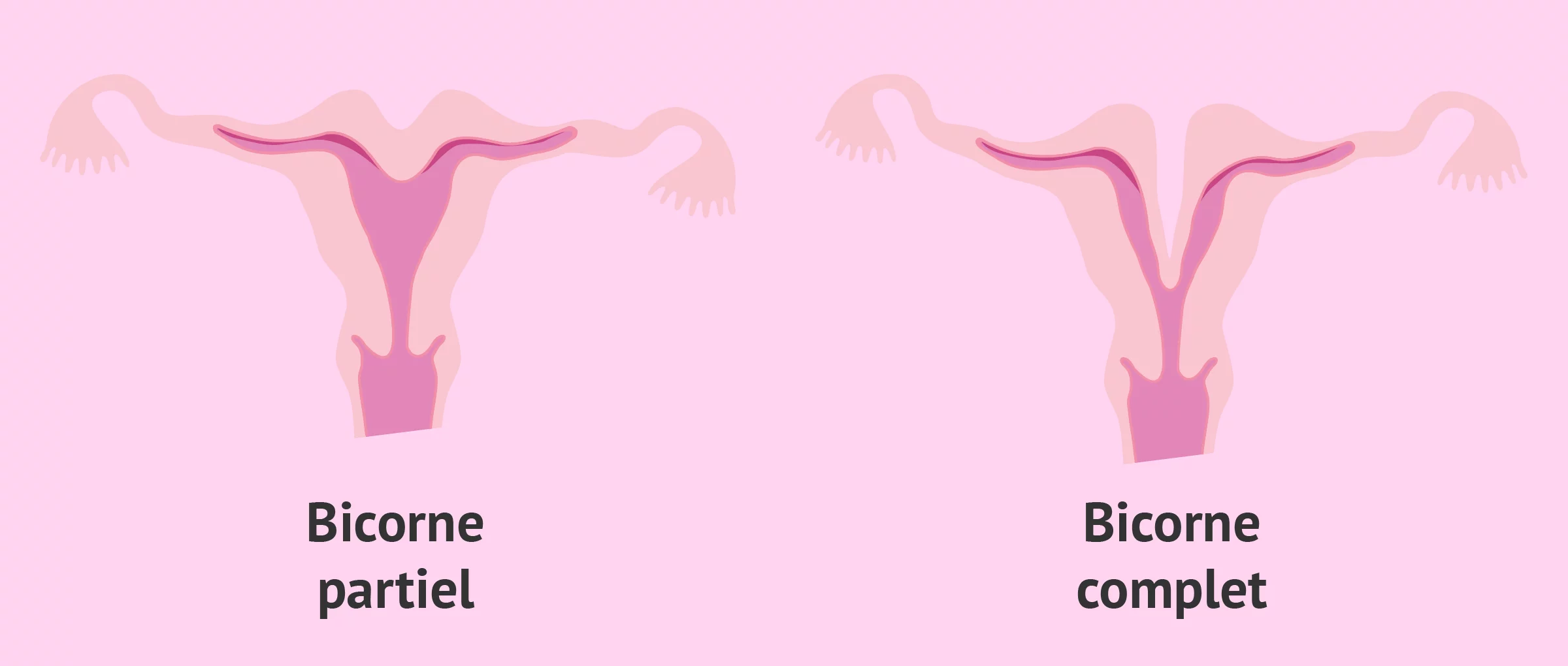 Types d'utérus bicorne