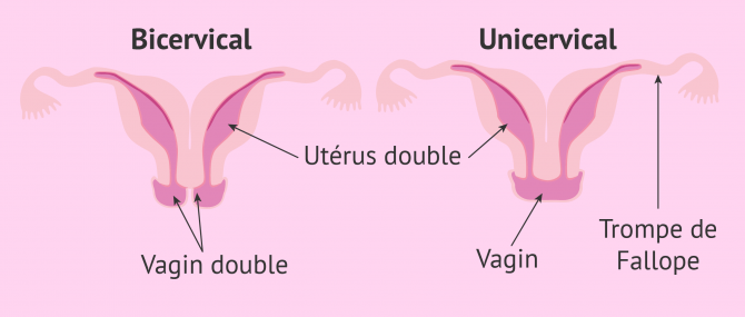 Imagen: utérus didelphe forme