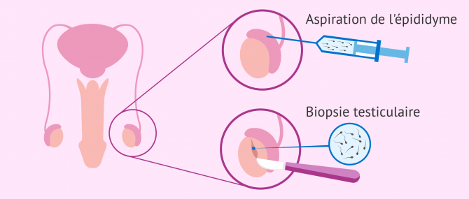 Imagen: biopsie testiculaire