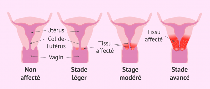 Imagen: cancer uterus