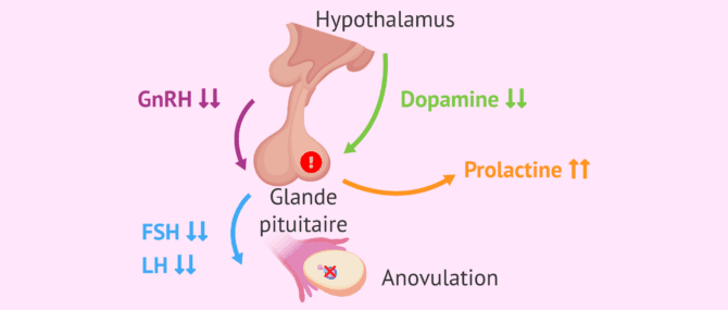Imagen: Cause la plus fréquente de l'hyperprolactinémie