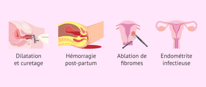 Imagen: Causes des synéchies utérines