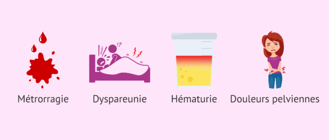 Imagen: Quelques signes possibles de l'endométriose