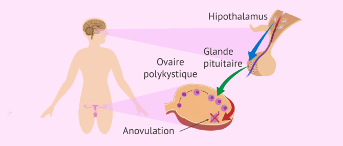Imagen: Anovulation chez les femmes atteintes du SOPK