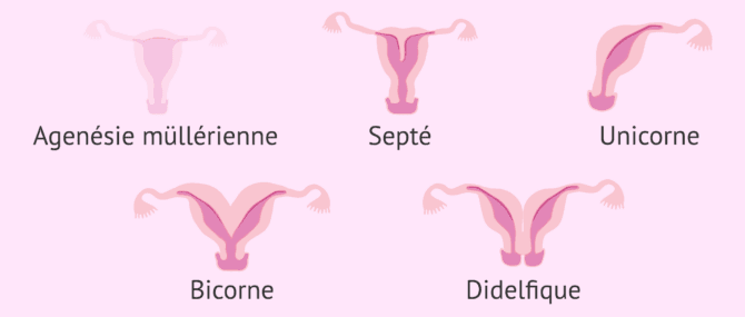Imagen: Différentes malformations utérines