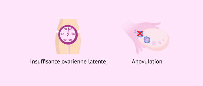 Imagen: Insuffisance ovarienne et anovulation