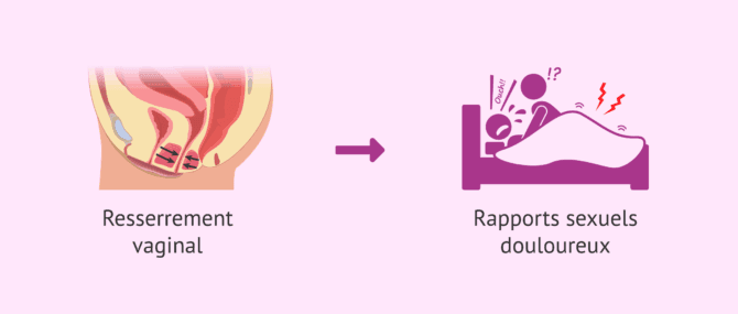 Imagen: Conséquence du vaginisme chez la femme