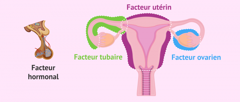 Facteurs qui causent l'infertilité féminine