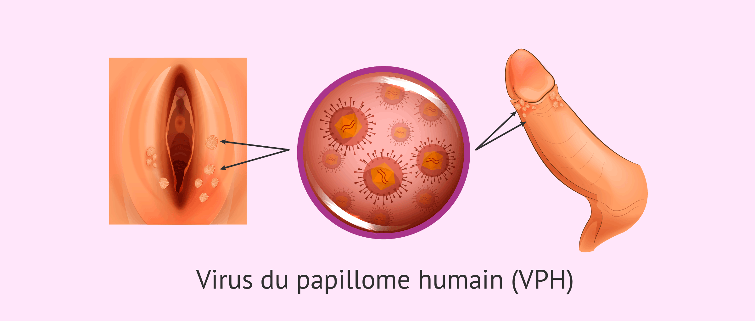 Le virus du papillome humain (VPH): Types, causes, symptômes et vaccins