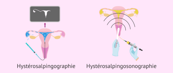 Imagen: Types d'hystérosalpingographie