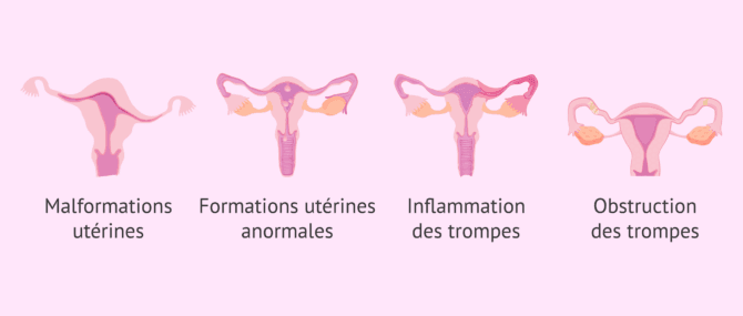 Imagen: Informations apportées par l'hystérosalpingographie