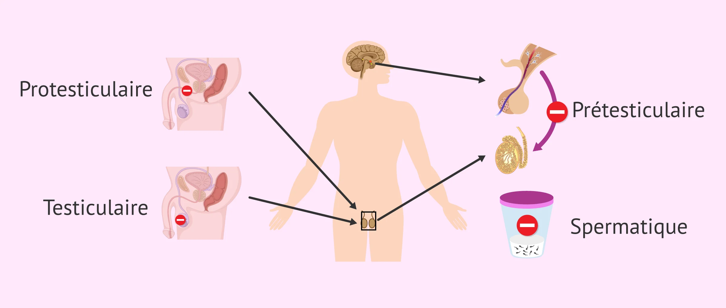 Qu'est-ce que l'infertilité ? - Causes, diagnostic et traitement