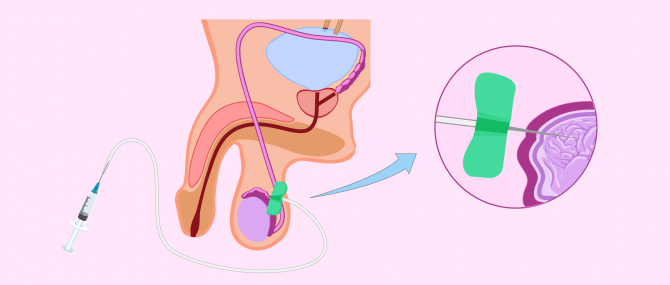 Imagen: aspiration percutanee