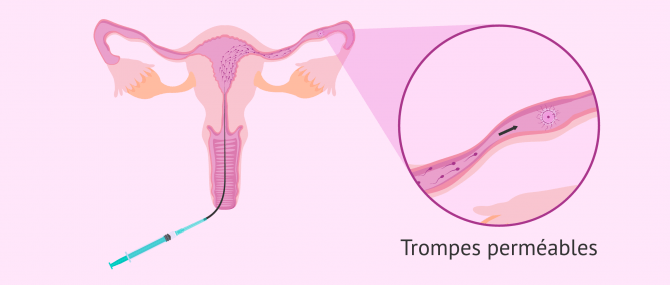 Imagen: IA fécondation dans les trompes