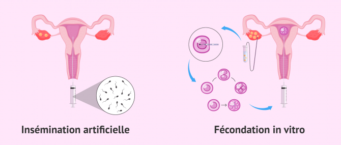 Imagen: Technique de reproduction assistée