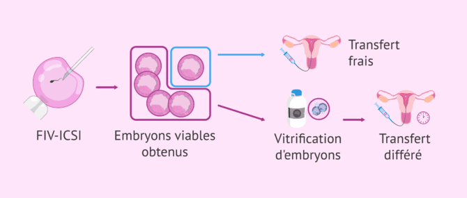 Imagen: Résultats périnatals après transfert frais ou différé